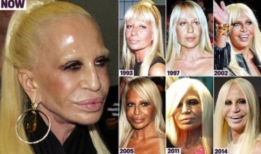 Donatella-Versace-bad-plastic-surgery